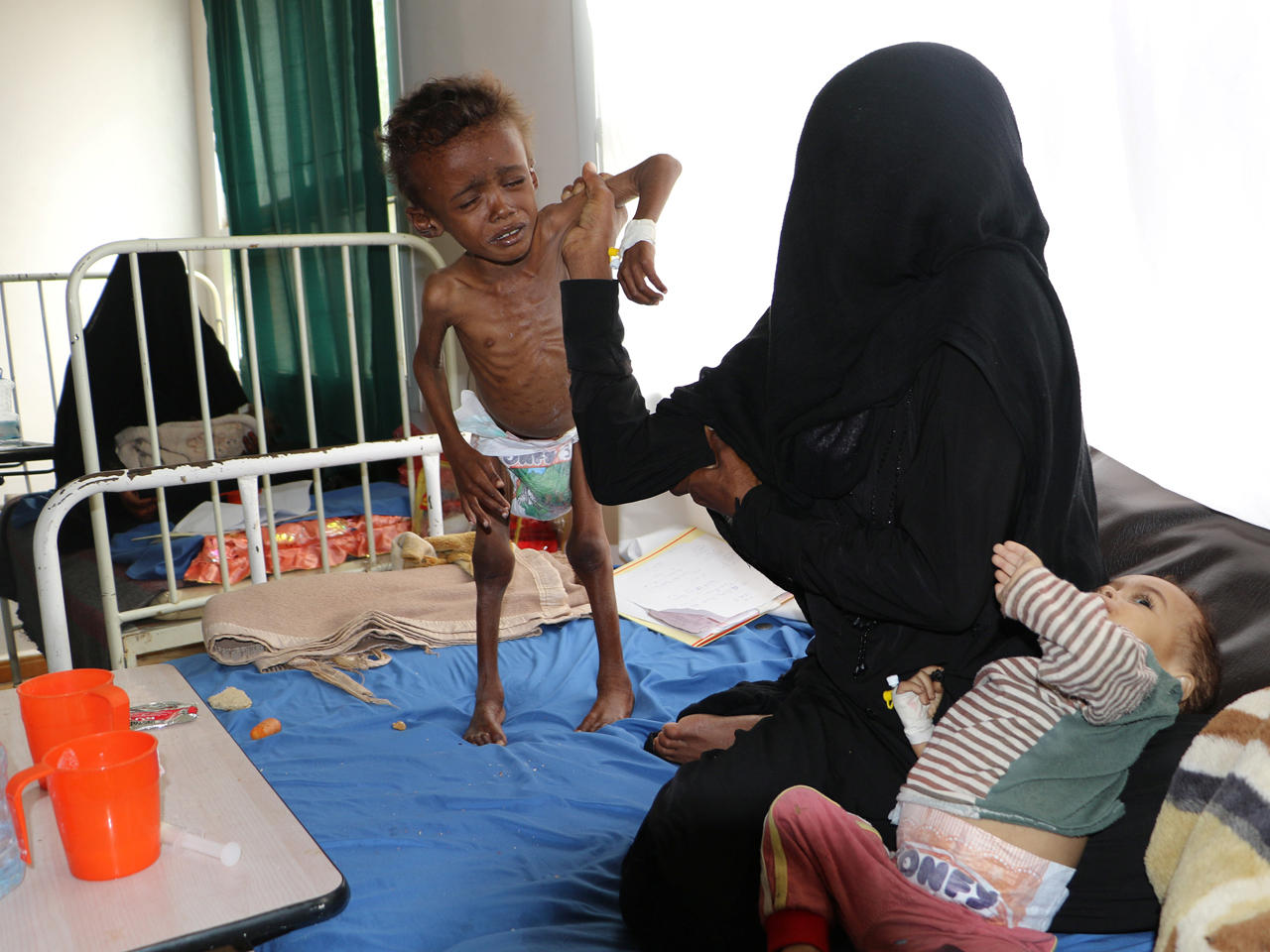 الطفل جمال مجلي المشرقي (4 أعوام) الذي يعاني من سوء التغذية بجانب والدته في مستشفى بمدينة صعدة شمال غرب اليمن