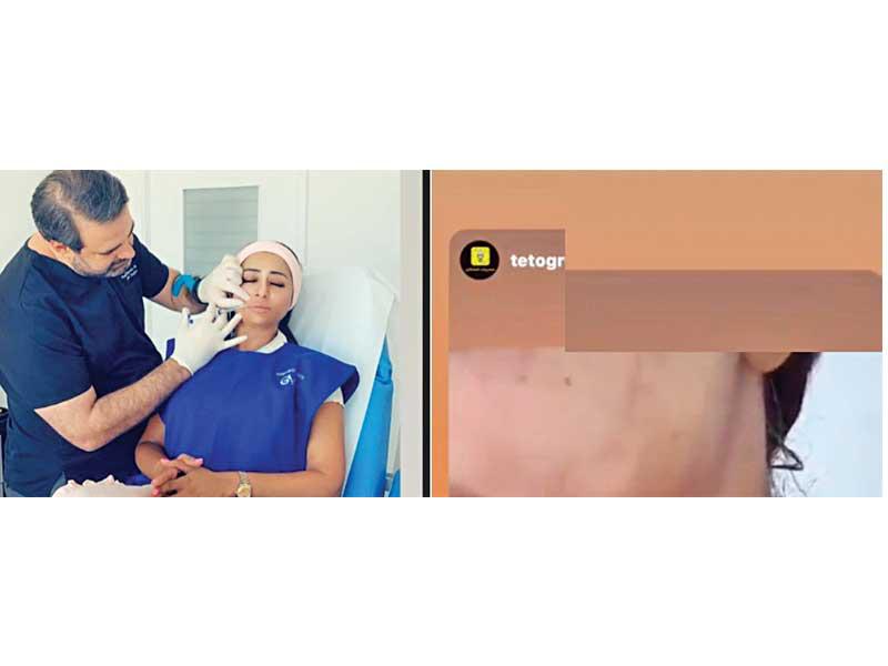 شيماء سبت تعالج من الحروق 