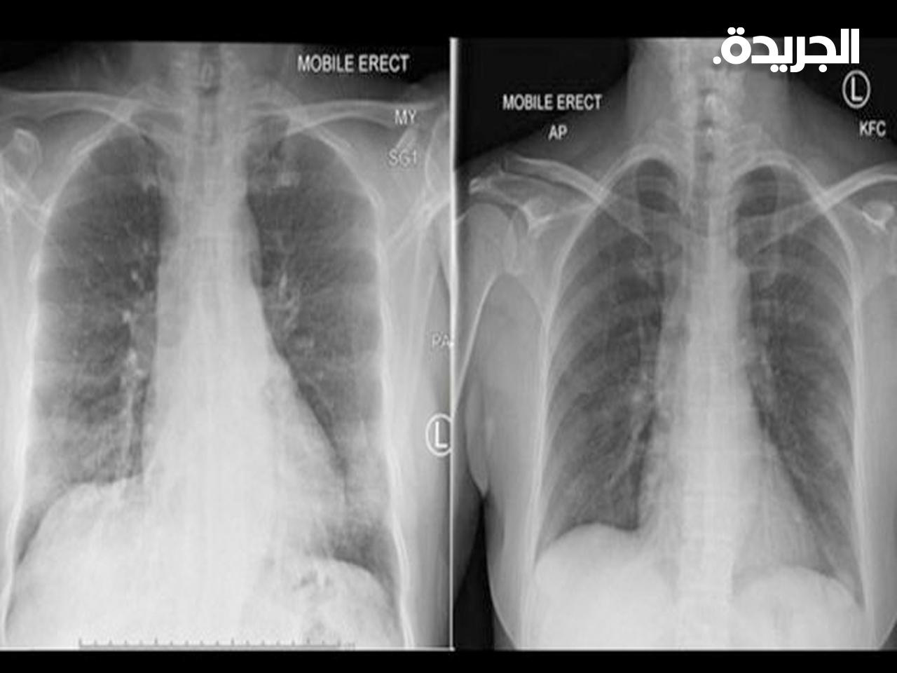 أظهرت عمليات مسح الصدر تطهير رئتي المريض بعد ظهور خلايا مناعية