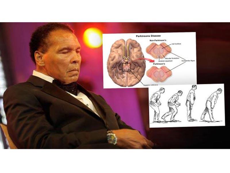 الملاكم العالمي للوزن الثقيل محمد علي كلاي والذي توفى بسبب مرض الباركنسون (مرض الرعاش)