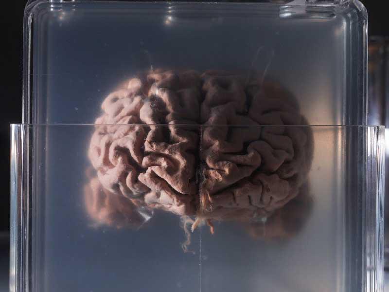 حالة تجميد دماغ