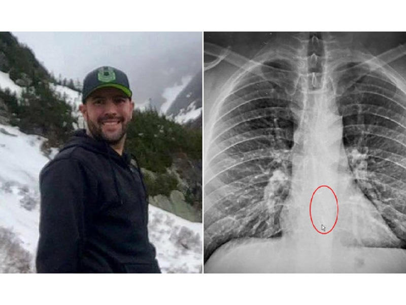 صورة أشعة تبين السماعة العالقة في مريئه