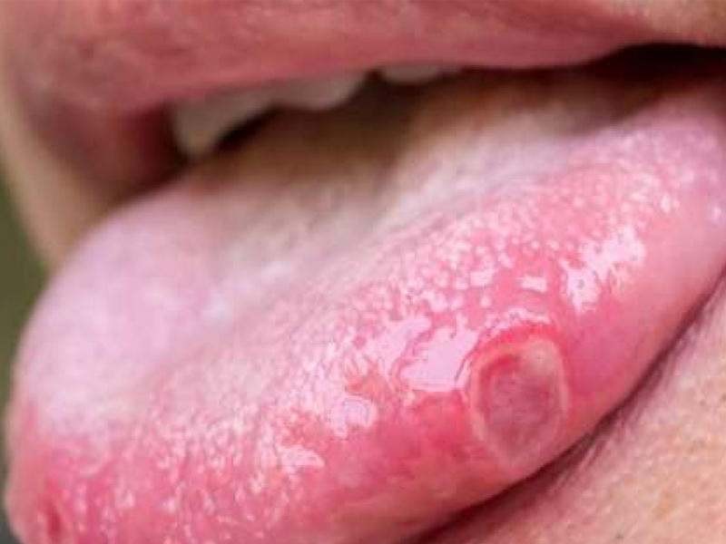 أعراض سرطان الفم