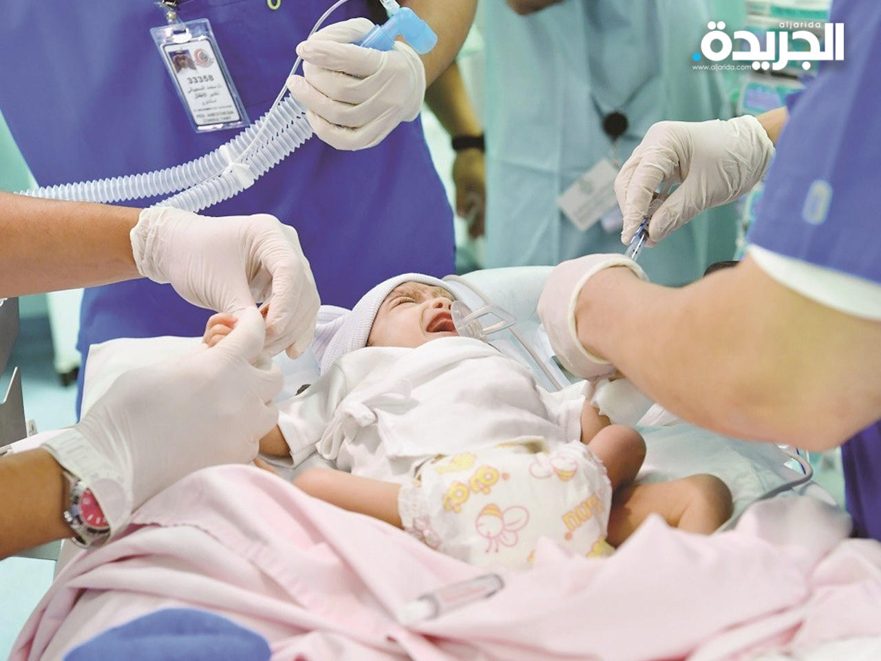 فريق طبي في السعودية ينجح في فصل رضيعة يمنية عن توأمها الطفيلي