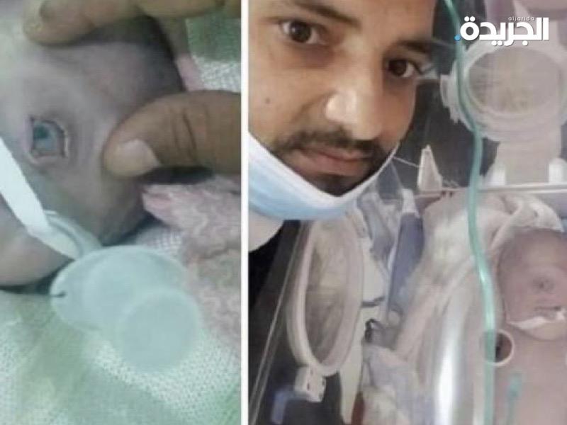 في حالة نادرة.. ولادة طفل يمني بعين واحدة