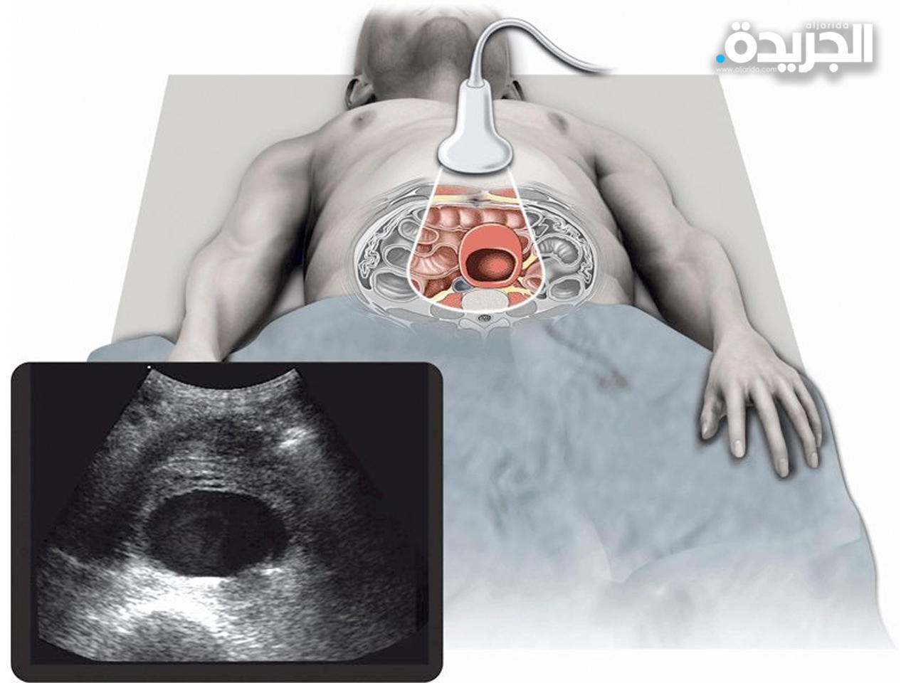 أول عملية في الكويت لعلاج تمدد الشريان الأورطي في البطن باستخدام السونار الداخلي