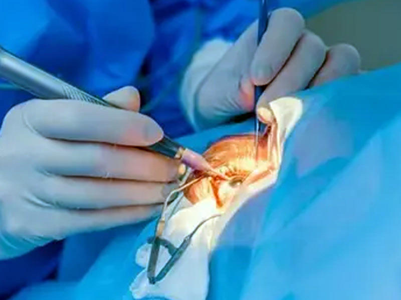 عملية نادرة، تمكّن فريق طبي مصري من استخراج قلم من عين طفل