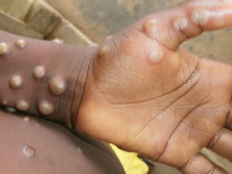 احد الاشخاص مصابا بجدري القرود