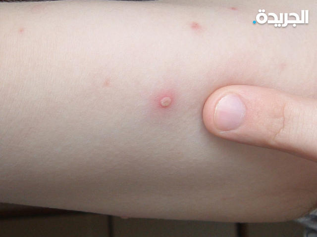 تسجيل أول إصابة بـ «جدري القرود» في الولايات المتحدة