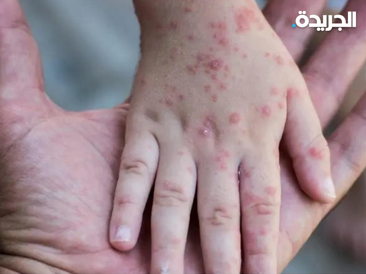 أحد أعراض الإصابة بفيروس جدري القرود