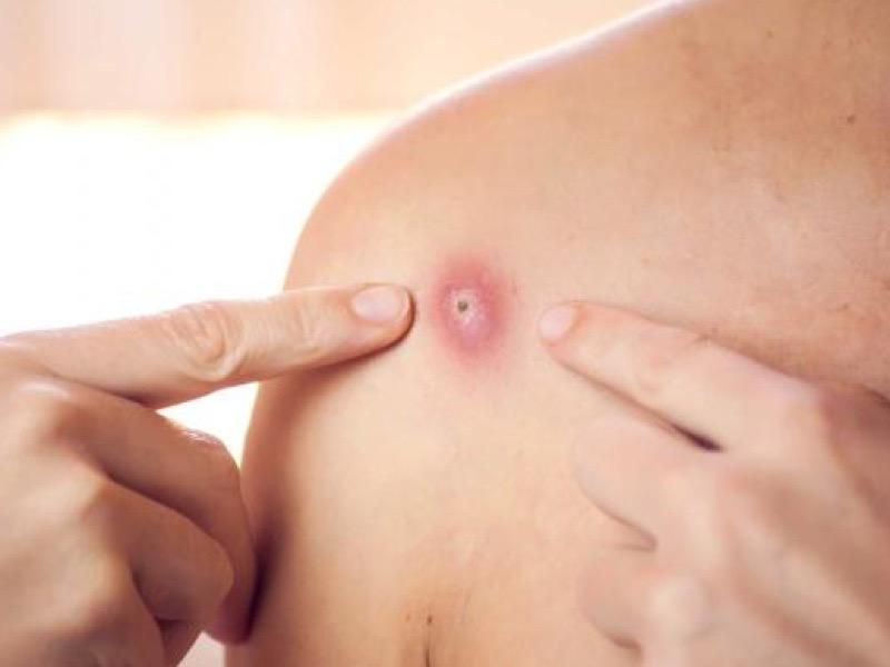 مرض جدري القرود