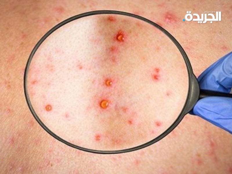 مرض جدري القرود