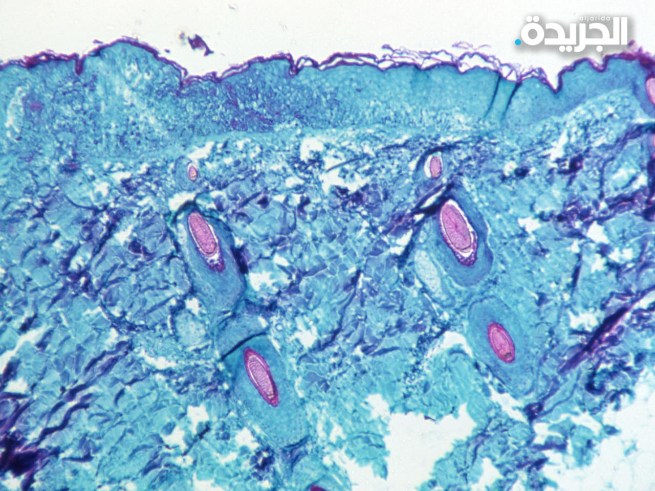 فيروس «جدري القرود» تحت المجهر