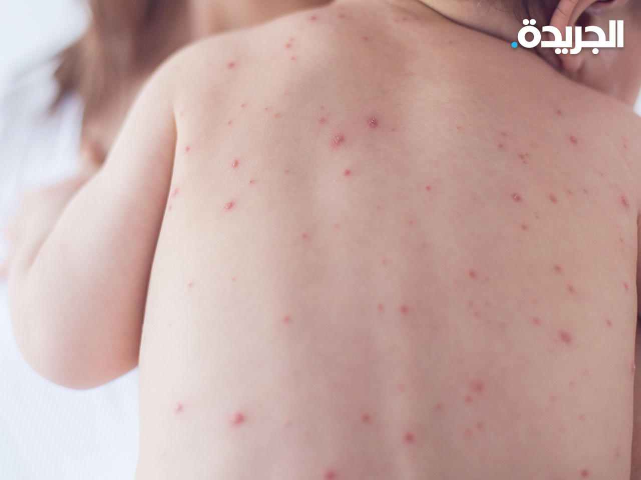 «السعودية»: لم نسجل أي إصابة بجدري القردة في المملكة 