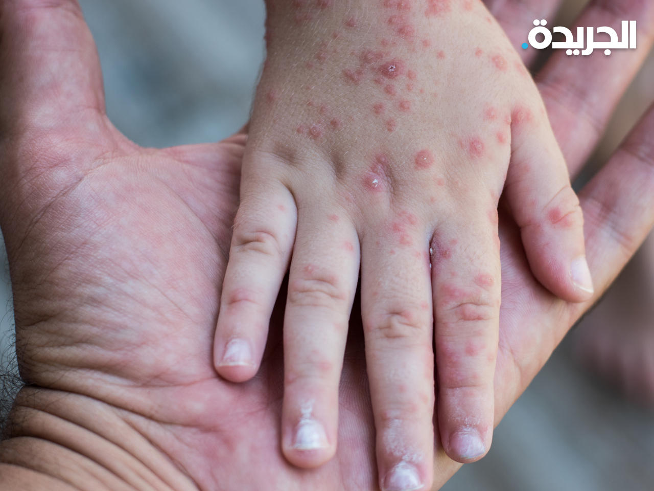 سويسرا تؤكد أول حالة إصابة بجدري القرود