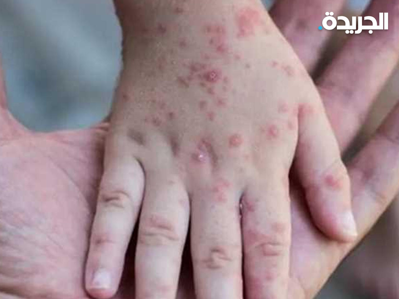 النمسا تؤكد أول إصابة بجدري القرود