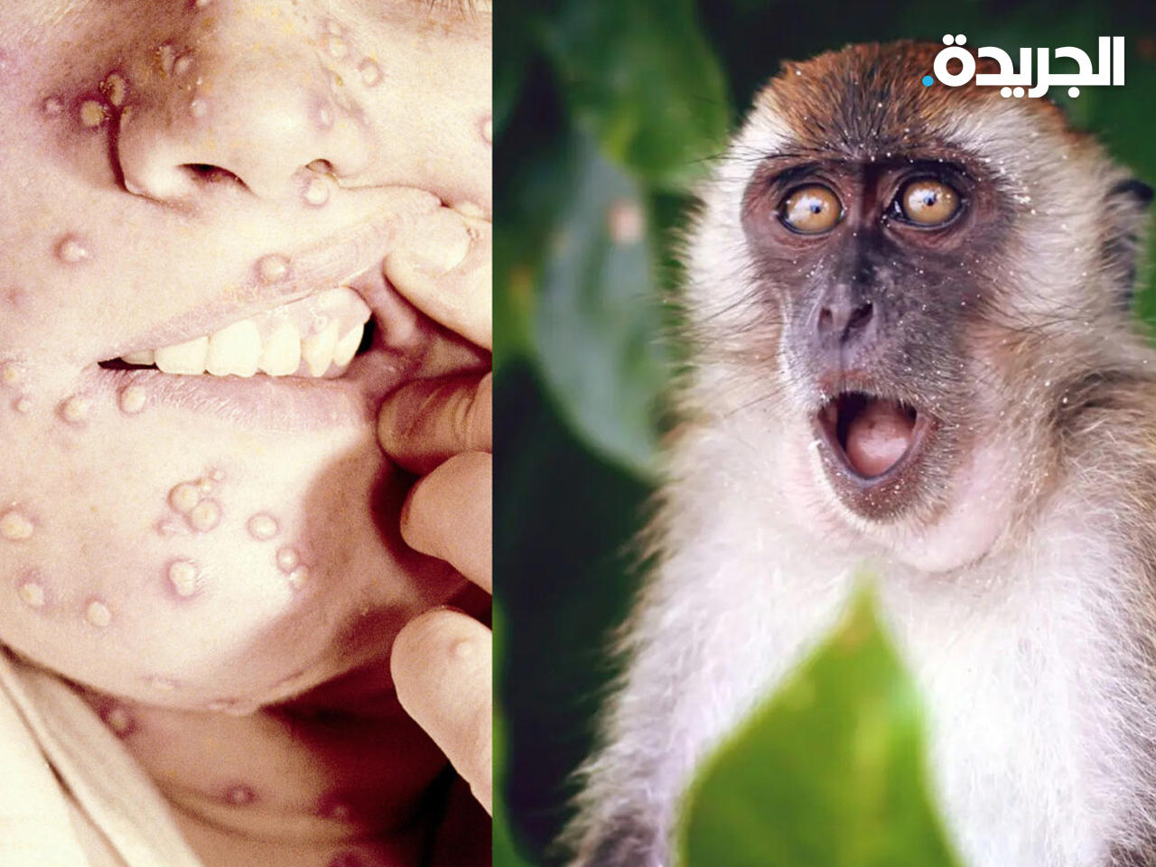 جدري القردة