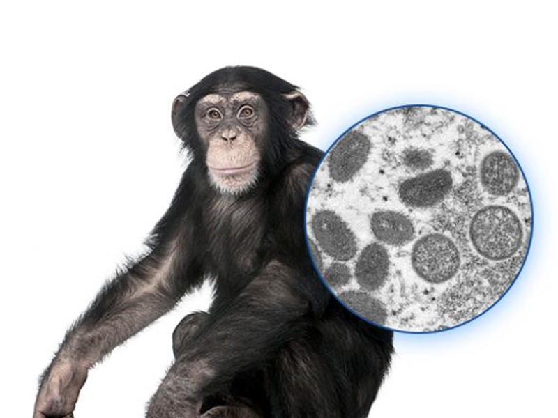 فيروس جدري القرود 