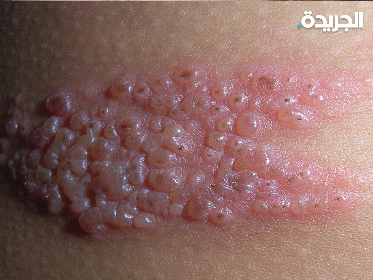 الطفح الجلدي