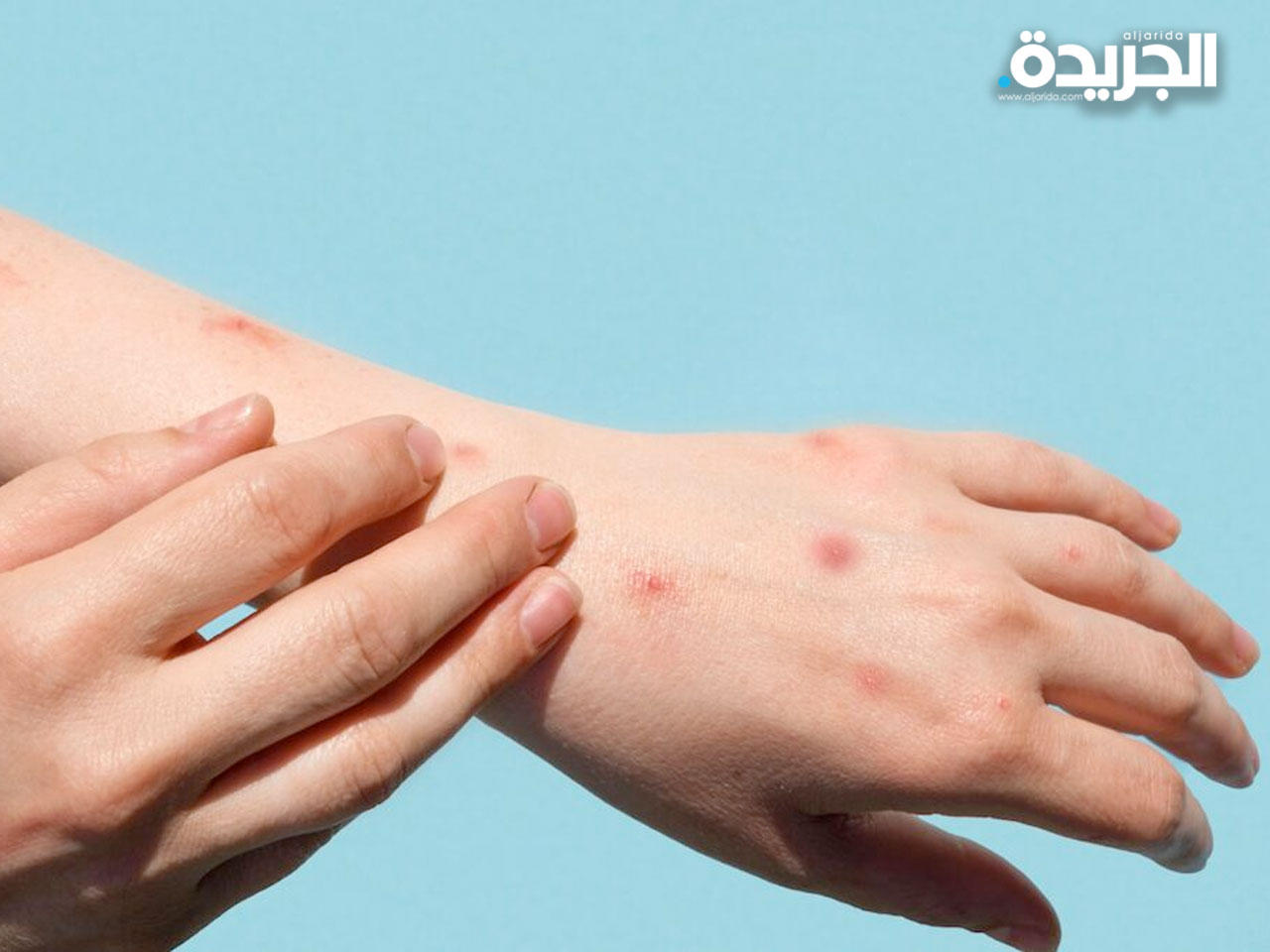 جدري القردة