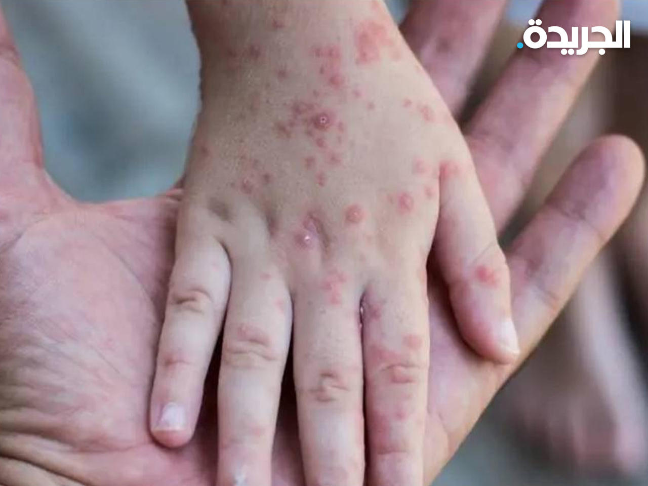 جدري القردة