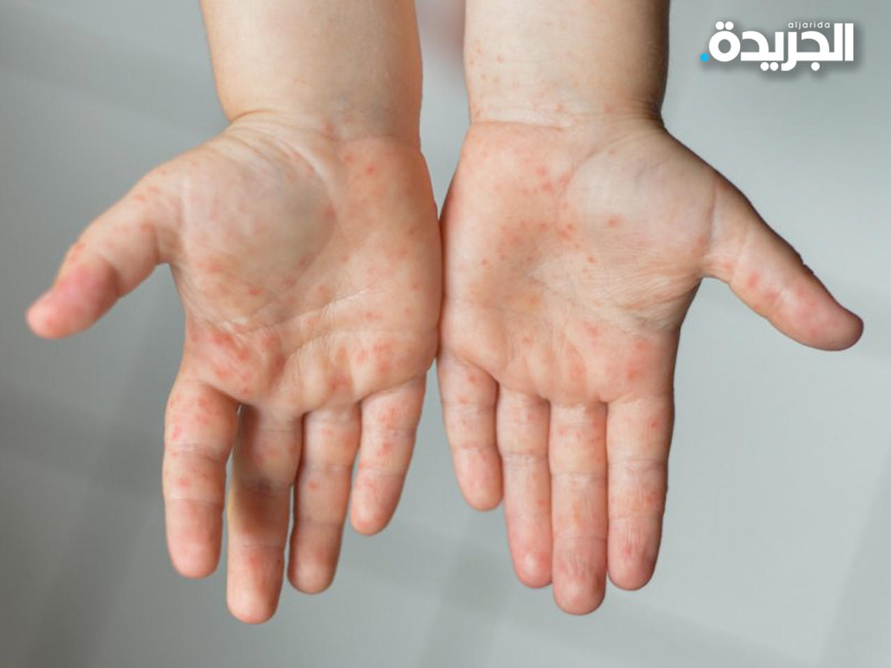 مرض جدري القردة