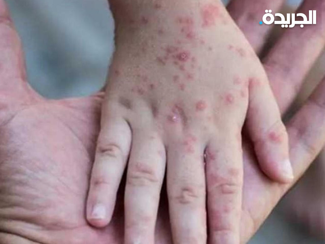 مرض جدري القردة