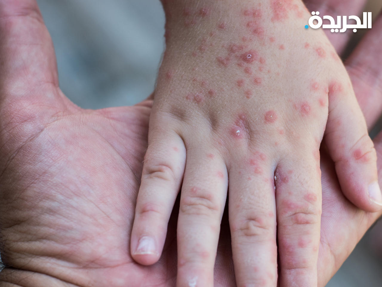 مرض جدري القردة