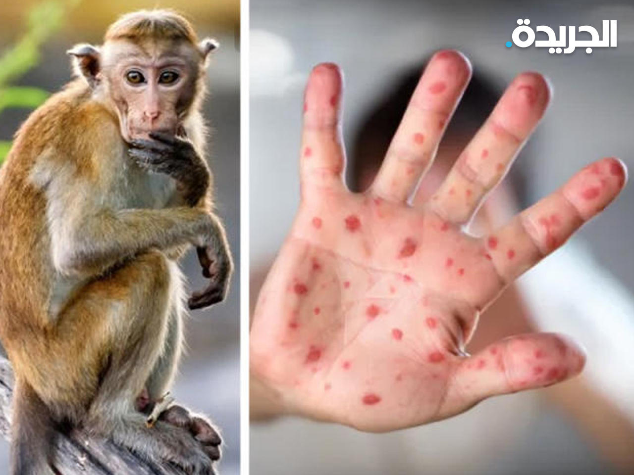 جدري القردة