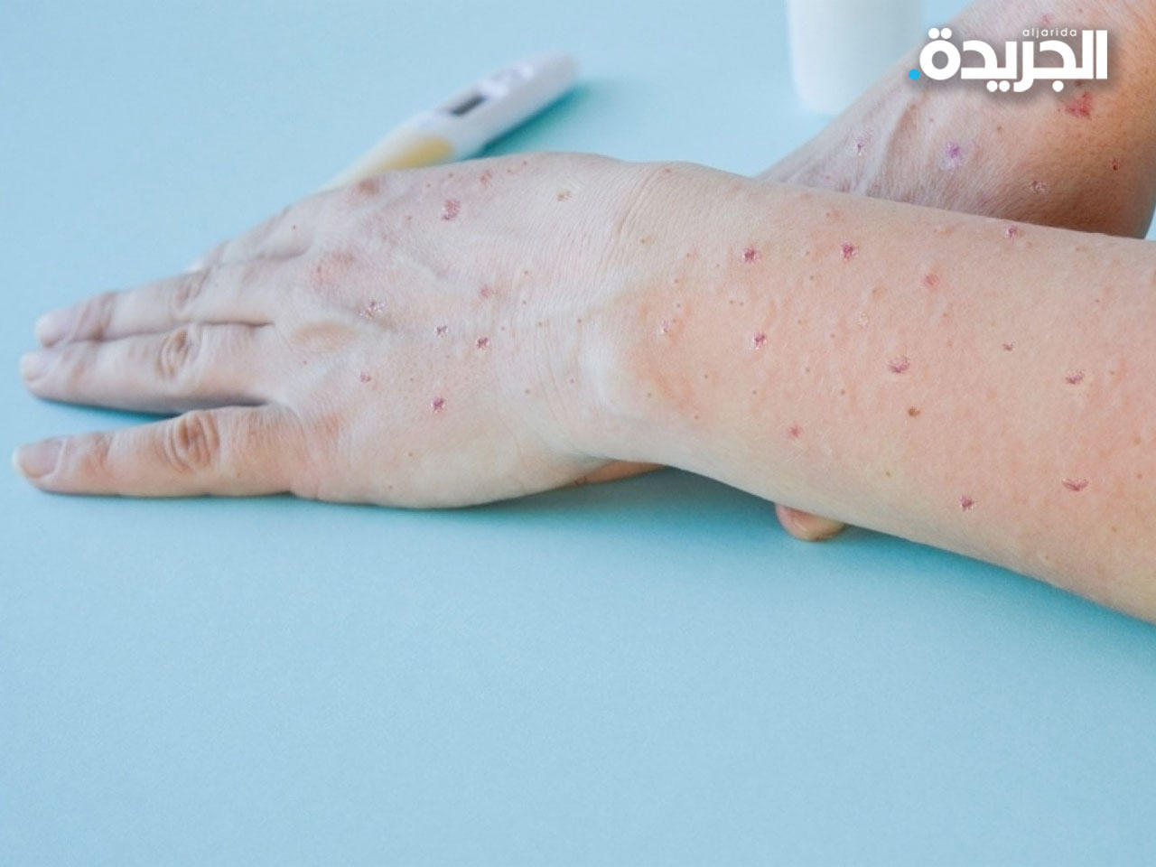 جدري القردة