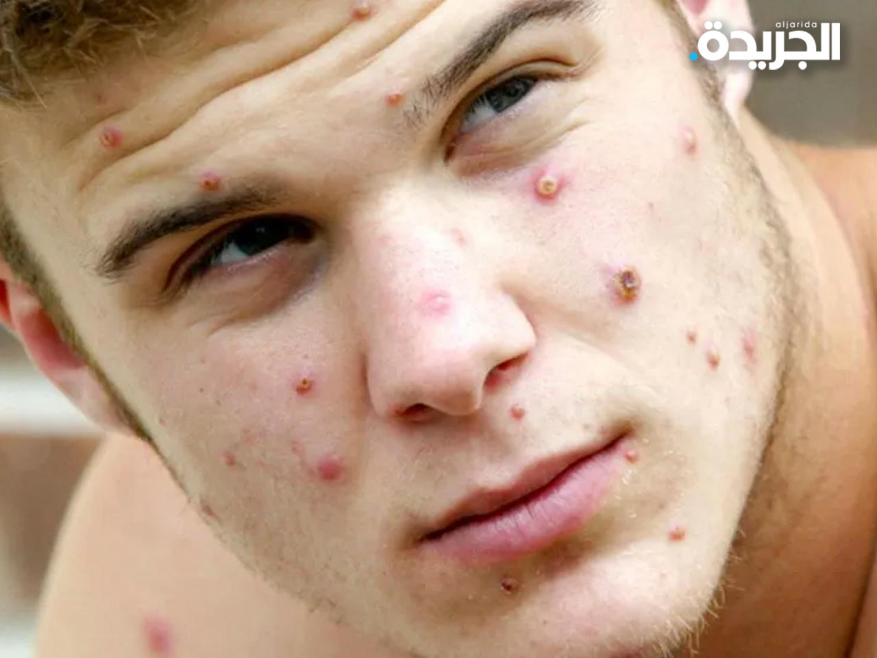 طالب مصاب بمرض جدري القرود «أسوشيتد برس»