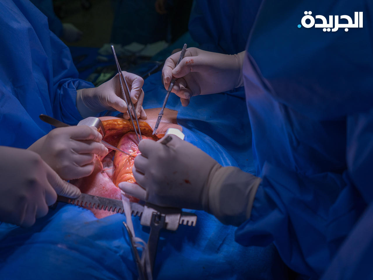 نجاح عمليتي زرع قلبي خنزيرين لشخصين ميتين دماغياً