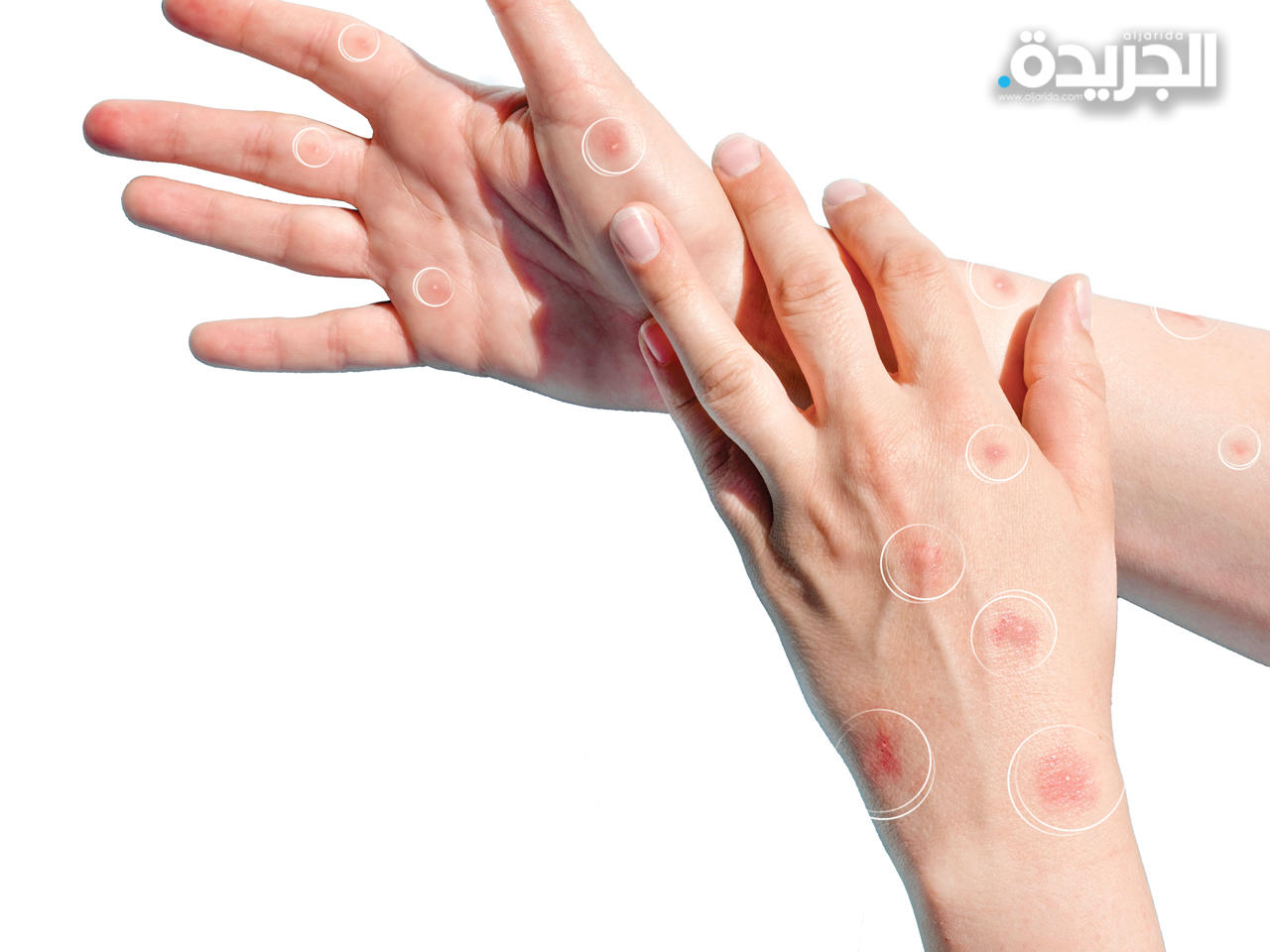 أكثر من 2000 إصابة بجدري القرود في ألمانيا