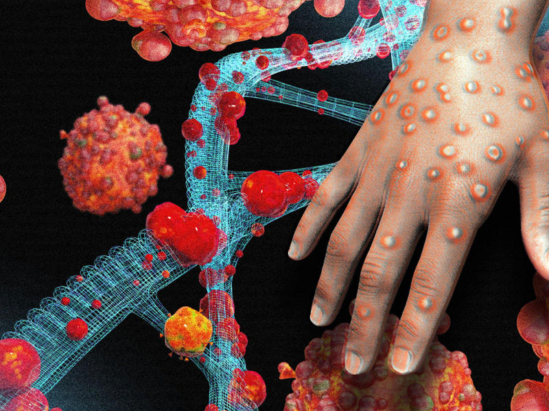 جدري القرود