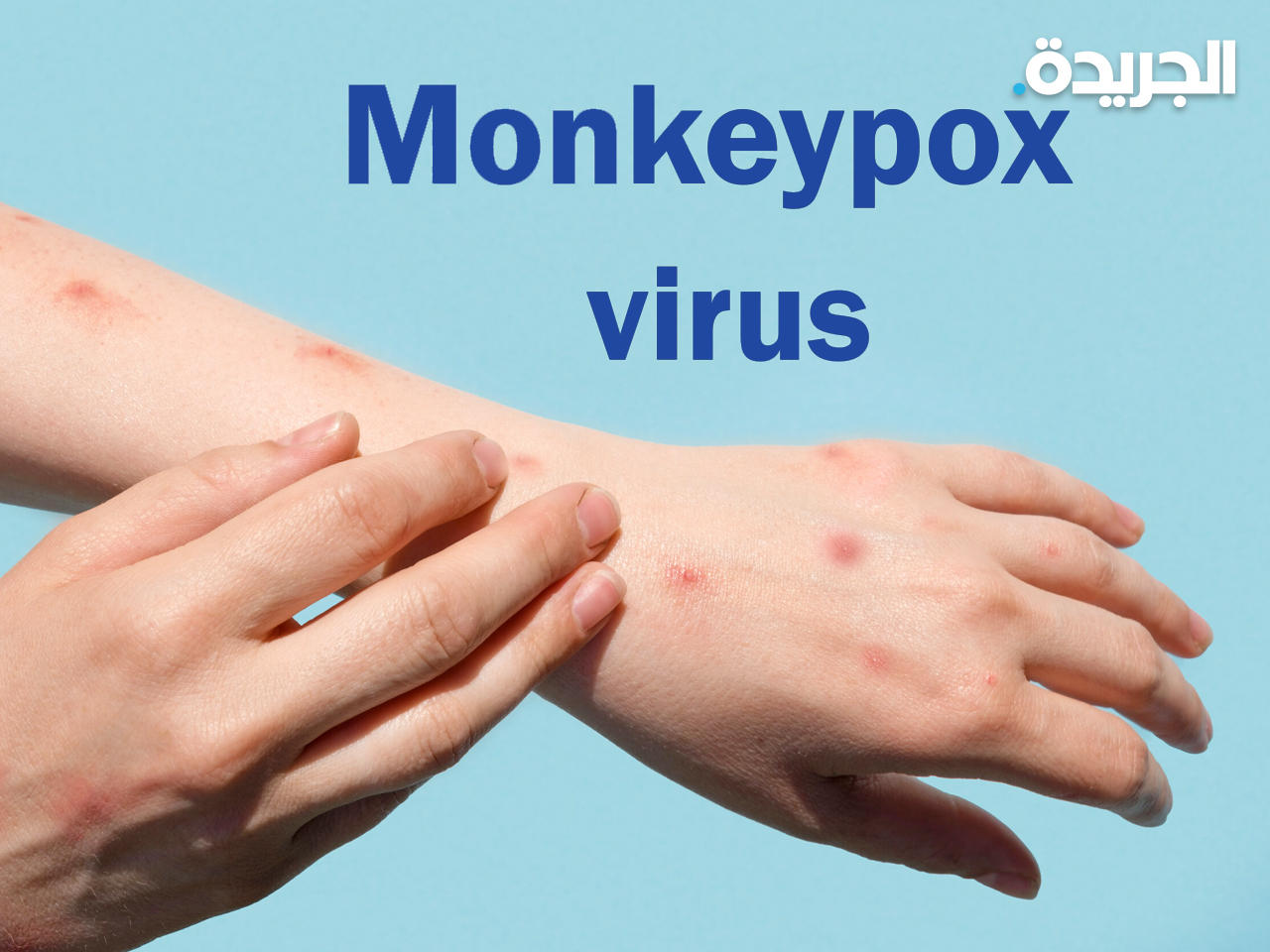 جدري القردة