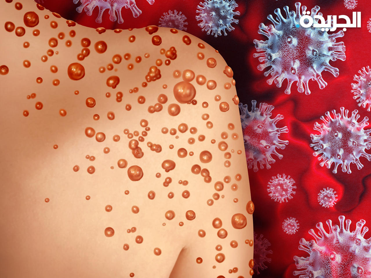 جدري القردة