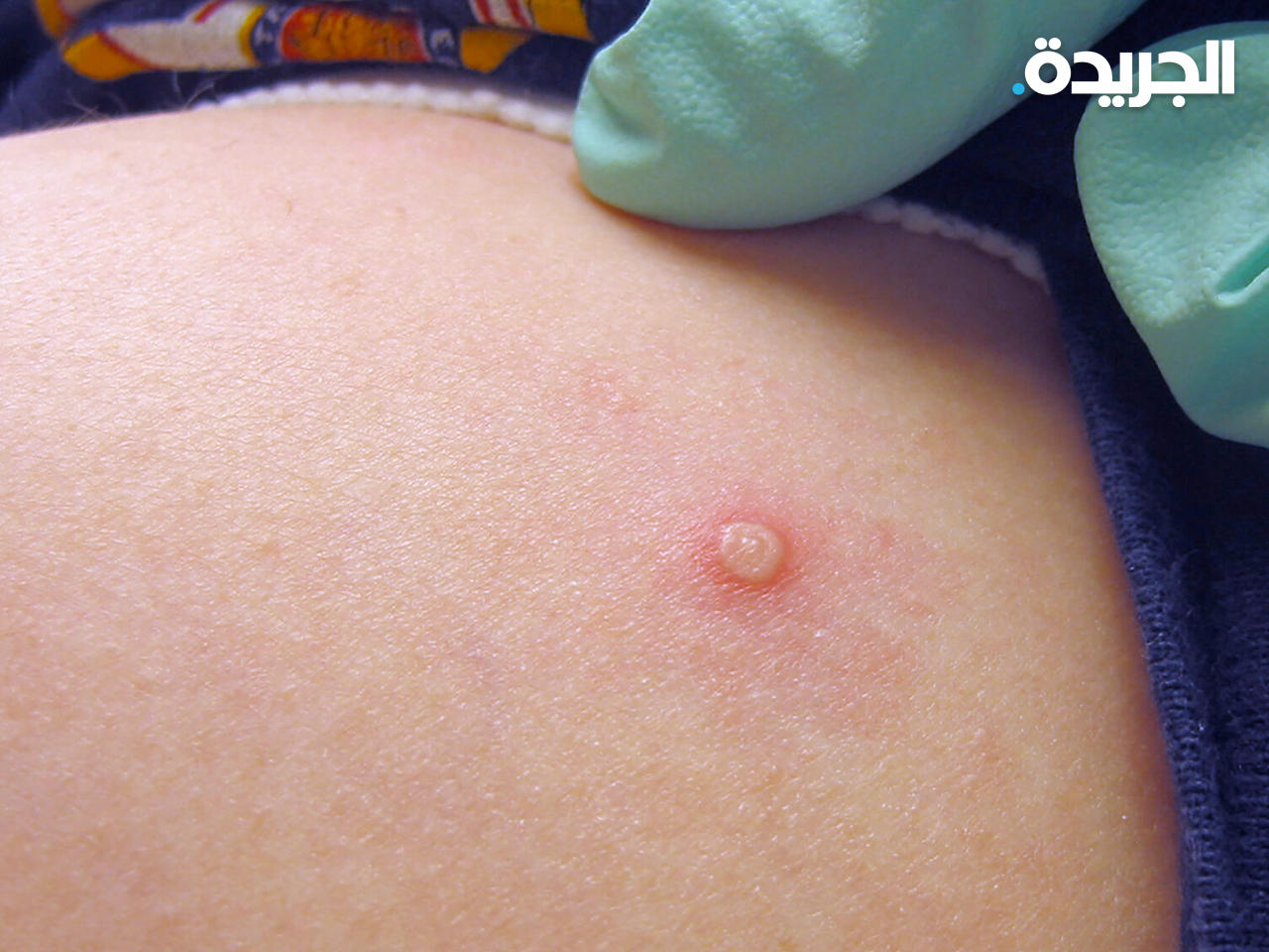 جدري القردة