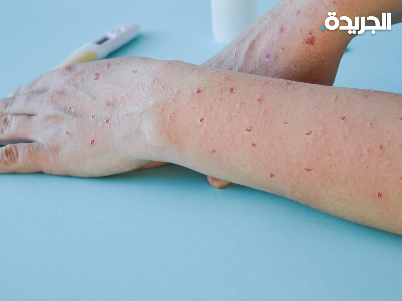 مصاب بجدري القردة