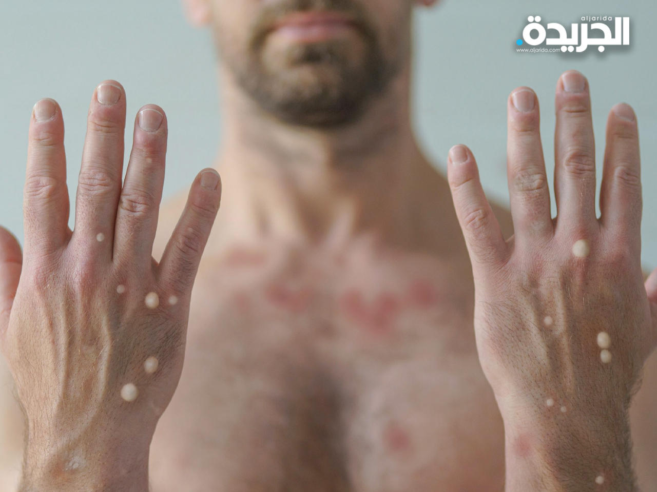 أعراض جدري القردة - أرشيفية