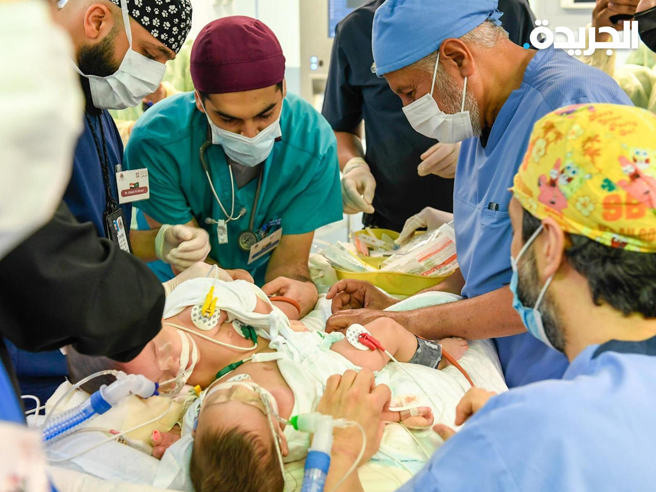 السعودية.. نجاح عملية فصل التوأم السيامي اليمني مودة ورحمة