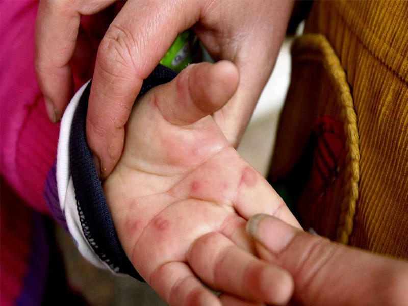 ظهور اعراض إنفلونزا الطماطم على يد احد الاطفال في الهند