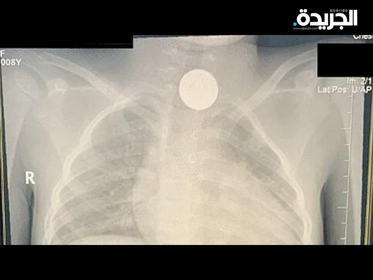 طفلة سعودية ابتلعت عملة معدنية لمدة 4 سنوات