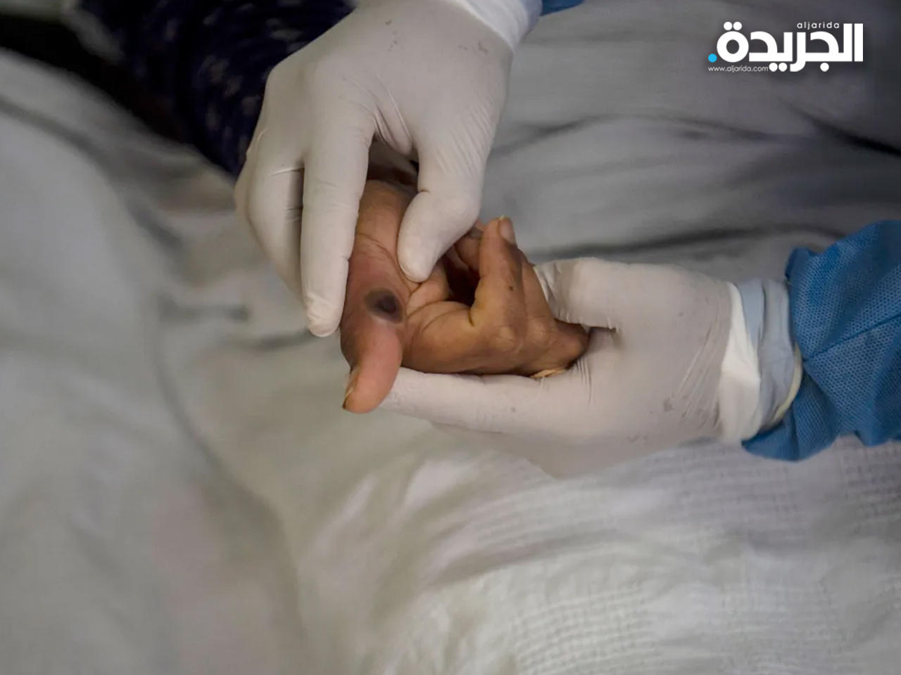 الولايات المتحدة تعلن أول وفاة مرتبطة بـ«جدري القرود»