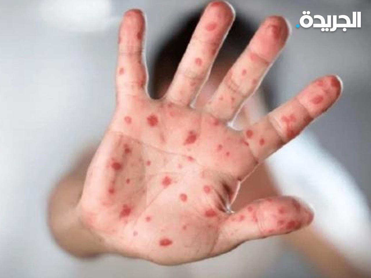 مصر ترصد أول حالة إصابة بجدري القرود