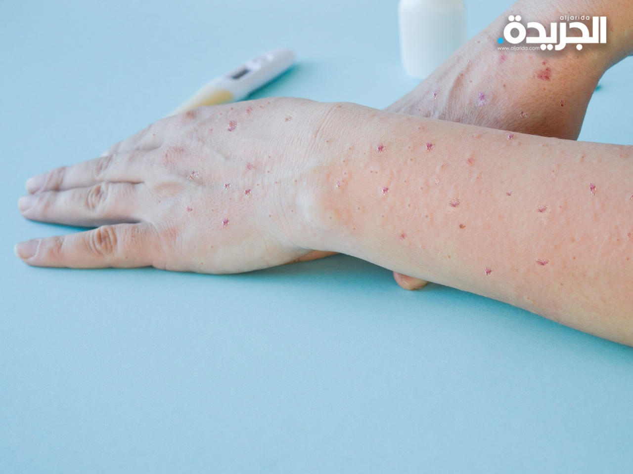 الأردن تسجل أول إصابة بفيروس جدري القردة