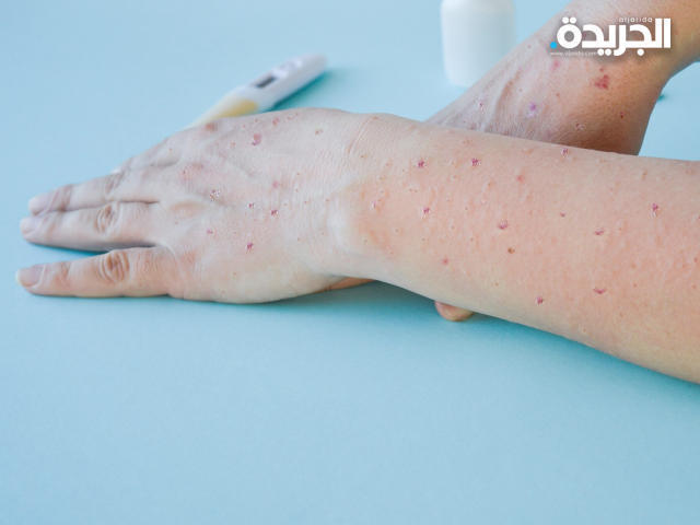 إصابة بجدري القردة