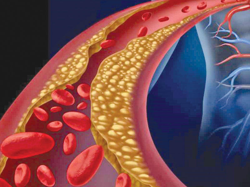  ارتفاع الكوليسترول في الدم